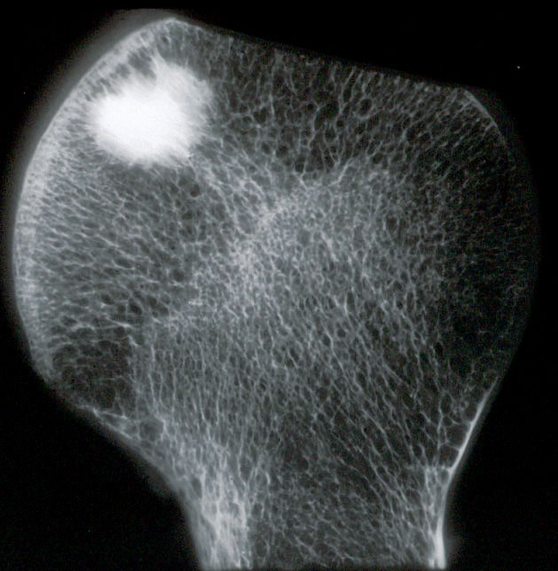 Pathology Outlines Bone island